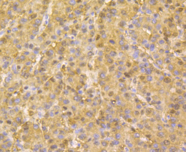 Immunohistochemical analysis of paraffin-embedded human liver cancer tissue using anti-ACY-1 antibody. The section was pre-treated using heat mediated antigen retrieval with Tris-EDTA buffer (pH 8.0-8.4) for 20 minutes.The tissues were blocked in 5% BSA for 30 minutes at room temperature, washed with ddH2O and PBS, and then probed with the antibody (ER1803-75) at 1/200 dilution, for 30 minutes at room temperature and detected using an HRP conjugated compact polymer system. DAB was used as the chrogen. Counter stained with hematoxylin and mounted with DPX.