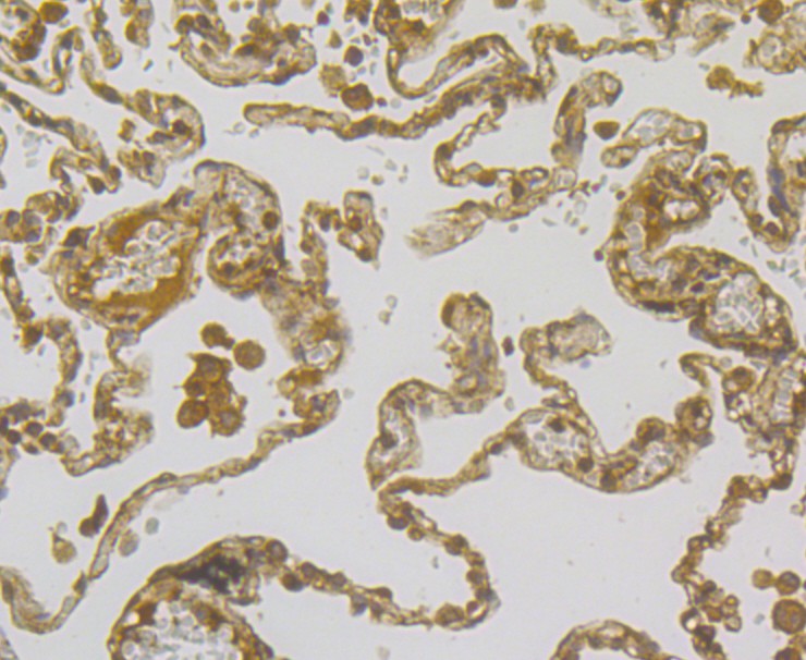 Immunohistochemical analysis of paraffin-embedded human lung cancer tissue using anti-Mesothelin antibody. The section was pre-treated using heat mediated antigen retrieval with Tris-EDTA buffer (pH 8.0-8.4) for 20 minutes. The tissues were blocked in 5% BSA for 30 minutes at room temperature, washed with ddH2O and PBS, and then probed with the antibody (ER1803-76) at 1/100 dilution, for 30 minutes at room temperature and detected using an HRP conjugated compact polymer system. DAB was used as the chrogen. Counter stained with hematoxylin and mounted with DPX.
