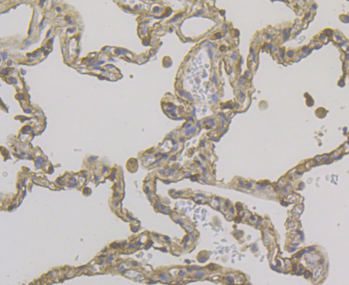 Immunohistochemical analysis of paraffin-embedded human lung cancer tissue using anti-Cytokeratin 19 antibody. The section was pre-treated using heat mediated antigen retrieval with sodium citrate buffer (pH 6.0) for 20 minutes. The tissues were blocked in 5% BSA for 30 minutes at room temperature, washed with ddH2O and PBS, and then probed with the antibody (ER1803-79) at 1/200 dilution, for 30 minutes at room temperature and detected using an HRP conjugated compact polymer system. DAB was used as the chrogen. Counter stained with hematoxylin and mounted with DPX.