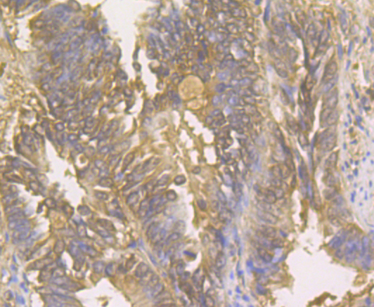Immunohistochemical analysis of paraffin-embedded human colon cancer tissue using anti-Galectin 3 antibody. The section was pre-treated using heat mediated antigen retrieval with Tris-EDTA buffer (pH 8.0-8.4) for 20 minutes.The tissues were blocked in 5% BSA for 30 minutes at room temperature, washed with ddH2O and PBS, and then probed with the antibody (ER1803-82) at 1/200 dilution, for 30 minutes at room temperature and detected using an HRP conjugated compact polymer system. DAB was used as the chrogen. Counter stained with hematoxylin and mounted with DPX.