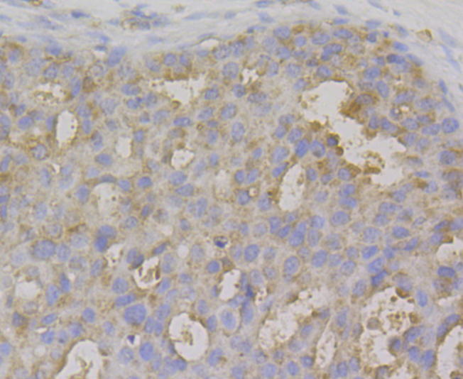Immunohistochemical analysis of paraffin-embedded human breasr cancer tissue using anti-IL-22 antibody. The section was pre-treated using heat mediated antigen retrieval with sodium citrate buffer (pH 6.0) for 20 minutes. The tissues were blocked in 5% BSA for 30 minutes at room temperature, washed with ddH2O and PBS, and then probed with the antibody (ER1803-85) at 1/200 dilution, for 30 minutes at room temperature and detected using an HRP conjugated compact polymer system. DAB was used as the chrogen. Counter stained with hematoxylin and mounted with DPX.