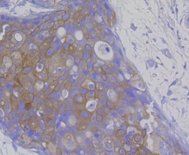 Immunohistochemical analysis of paraffin-embedded human breast cancer tissue using anti-Cytokeratin 8 antibody. The section was pre-treated using heat mediated antigen retrieval with Tris-EDTA buffer (pH 8.0-8.4) for 20 minutes.The tissues were blocked in 5% BSA for 30 minutes at room temperature, washed with ddH2O and PBS, and then probed with the antibody (ER1803-87) at 1/200 dilution, for 30 minutes at room temperature and detected using an HRP conjugated compact polymer system. DAB was used as the chromogen. Counter stained with hematoxylin and mounted with DPX.