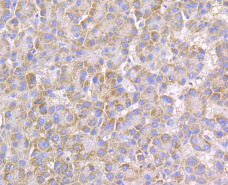 Immunohistochemical analysis of paraffin-embedded human liver cancer tissue using anti-Connexin 45 / GJA7 / Cx45 antibody. The section was pre-treated using heat mediated antigen retrieval with Tris-EDTA buffer (pH 8.0-8.4) for 20 minutes.The tissues were blocked in 5% BSA for 30 minutes at room temperature, washed with ddH2O and PBS, and then probed with the antibody (ER1803-93) at 1/50 dilution, for 30 minutes at room temperature and detected using an HRP conjugated compact polymer system. DAB was used as the chromogen. Counter stained with hematoxylin and mounted with DPX.