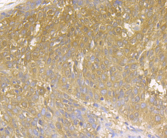 Immunohistochemical analysis of paraffin-embedded human lung cancer tissue using anti-MICA + MICB antibody. The section was pre-treated using heat mediated antigen retrieval with Tris-EDTA buffer (pH 8.0-8.4) for 20 minutes.The tissues were blocked in 5% BSA for 30 minutes at room temperature, washed with ddH2O and PBS, and then probed with the antibody (ER1803-95) at 1/50 dilution, for 30 minutes at room temperature and detected using an HRP conjugated compact polymer system. DAB was used as the chrogen. Counter stained with hematoxylin and mounted with DPX.