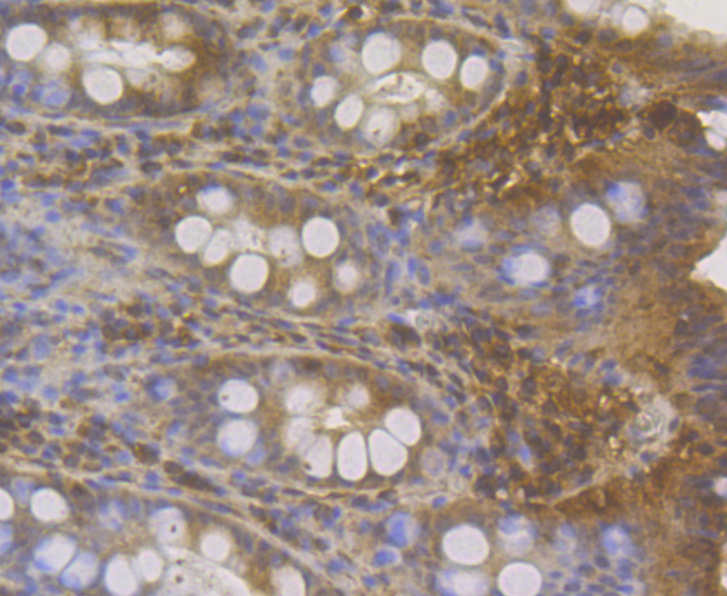 Immunohistochemical analysis of paraffin-embedded human colon tissue using anti-MICA + MICB antibody. The section was pre-treated using heat mediated antigen retrieval with Tris-EDTA buffer (pH 8.0-8.4) for 20 minutes.The tissues were blocked in 5% BSA for 30 minutes at room temperature, washed with ddH2O and PBS, and then probed with the antibody (ER1803-95) at 1/200 dilution, for 30 minutes at room temperature and detected using an HRP conjugated compact polymer system. DAB was used as the chrogen. Counter stained with hematoxylin and mounted with DPX.