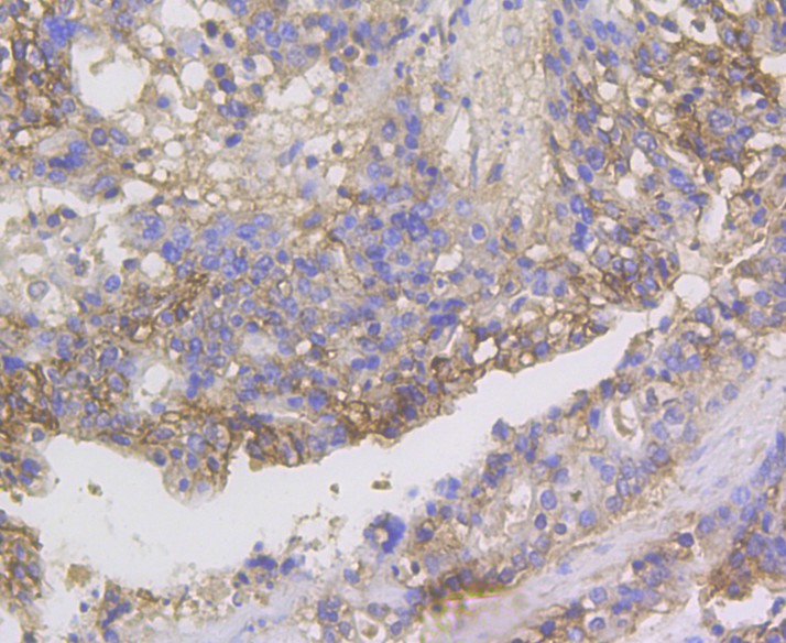 Immunohistochemical analysis of paraffin-embedded human stomach cancer tissue using anti-CDH17 antibody. The section was pre-treated using heat mediated antigen retrieval with Tris-EDTA buffer (pH 8.0-8.4) for 20 minutes.The tissues were blocked in 5% BSA for 30 minutes at room temperature, washed with ddH2O and PBS, and then probed with the antibody (ER1804-02) at 1/200 dilution, for 30 minutes at room temperature and detected using an HRP conjugated compact polymer system. DAB was used as the chromogen. Counter stained with hematoxylin and mounted with DPX.