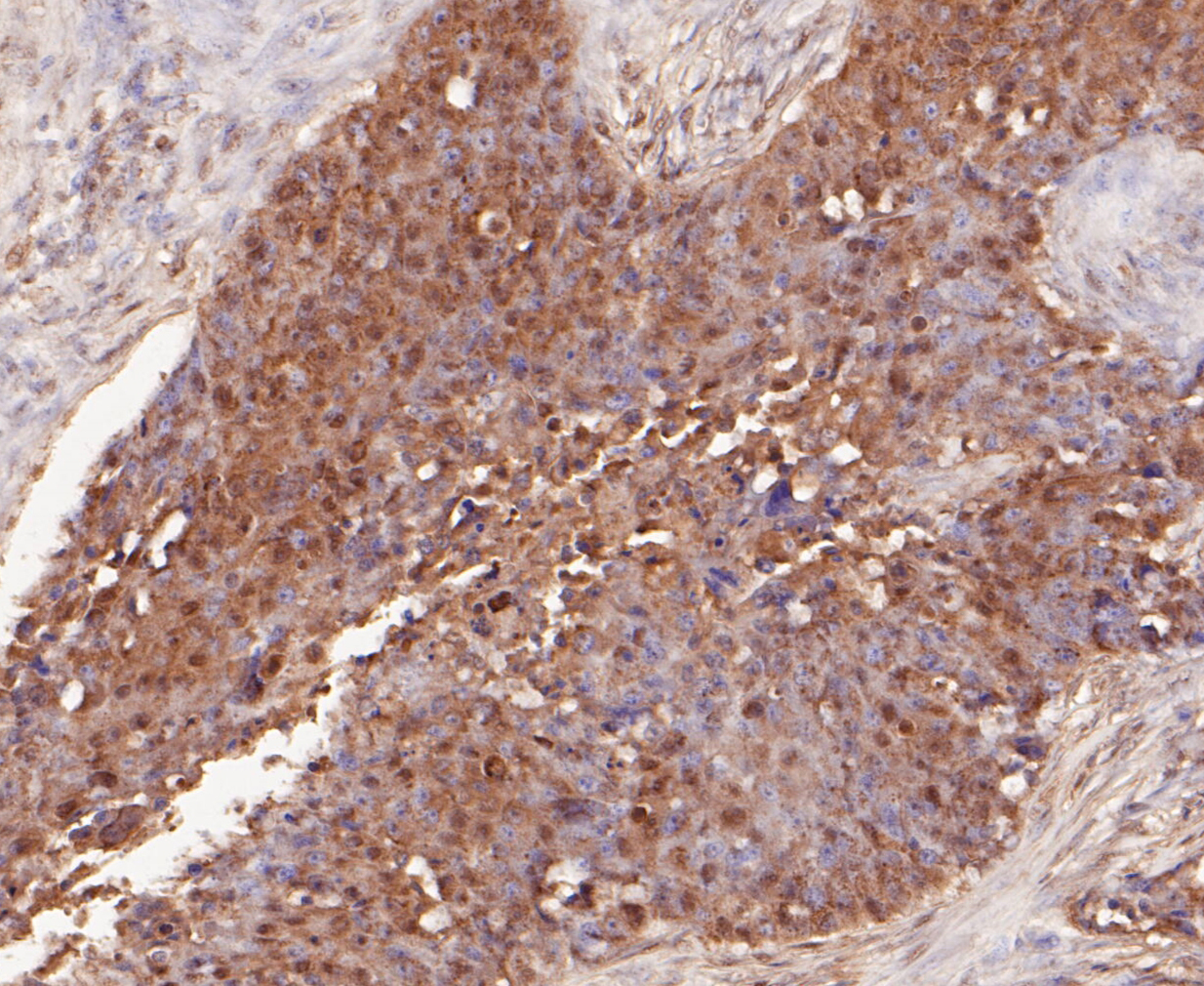 Immunohistochemical analysis of paraffin-embedded human breast cancer tissue using anti-delta 1 Catenin/CAS antibody. The section was pre-treated using heat mediated antigen retrieval with Tris-EDTA buffer (pH 8.0-8.4) for 20 minutes.The tissues were blocked in 5% BSA for 30 minutes at room temperature, washed with ddH2O and PBS, and then probed with the primary antibody (ER1901-07, 1/50) for 30 minutes at room temperature. The detection was performed using an HRP conjugated compact polymer system. DAB was used as the chromogen. Tissues were counterstained with hematoxylin and mounted with DPX.