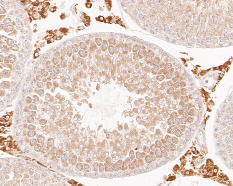 Immunohistochemical analysis of paraffin-embedded human liver carcinoma tissue using anti-FH antibody. The section was pre-treated using heat mediated antigen retrieval with Tris-EDTA buffer (pH 8.0-8.4) for 20 minutes.The tissues were blocked in 5% BSA for 30 minutes at room temperature, washed with ddH2O and PBS, and then probed with the primary antibody (ER1901-10, 1/200) for 30 minutes at room temperature. The detection was performed using an HRP conjugated compact polymer system. DAB was used as the chromogen. Tissues were counterstained with hematoxylin and mounted with DPX.