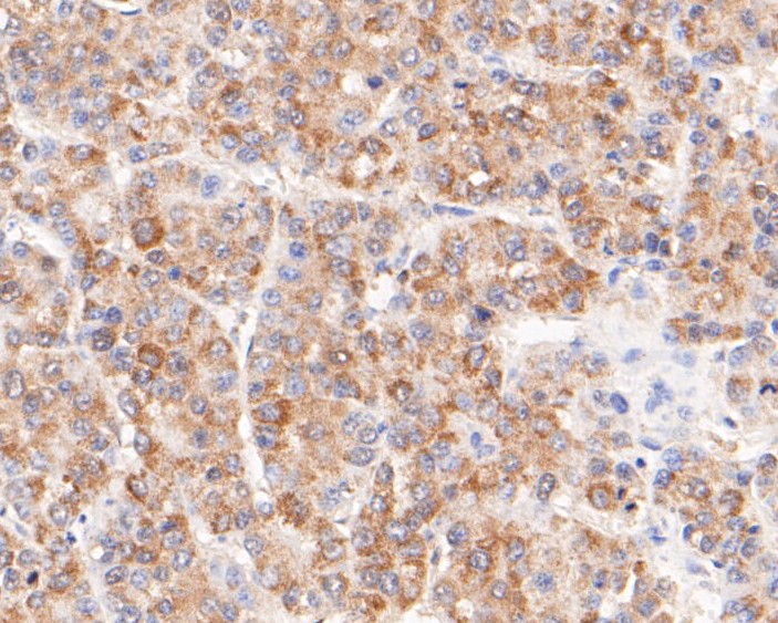 Immunohistochemical analysis of paraffin-embedded human liver carcinoma tissue using anti-FH antibody. The section was pre-treated using heat mediated antigen retrieval with Tris-EDTA buffer (pH 8.0-8.4) for 20 minutes.The tissues were blocked in 5% BSA for 30 minutes at room temperature, washed with ddH2O and PBS, and then probed with the primary antibody (ER1901-10, 1/200) for 30 minutes at room temperature. The detection was performed using an HRP conjugated compact polymer system. DAB was used as the chromogen. Tissues were counterstained with hematoxylin and mounted with DPX.