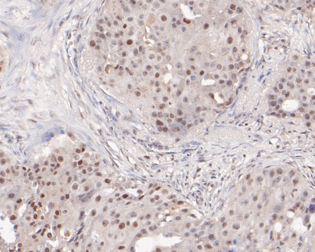 Immunohistochemical analysis of paraffin-embedded human breast cancer tissue using anti-SSRP1 antibody. The section was pre-treated using heat mediated antigen retrieval with sodium citrate buffer (pH 6.0) for 20 minutes. The tissues were blocked in 5% BSA for 30 minutes at room temperature, washed with ddH2O and PBS, and then probed with the primary antibody (ER1901-13, 1/50)  for 30 minutes at room temperature. The detection was performed using an HRP conjugated compact polymer system. DAB was used as the chromogen. Tissues were counterstained with hematoxylin and mounted with DPX.