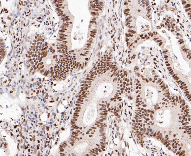 Immunohistochemical analysis of paraffin-embedded human colon cancer tissue using anti-SSB antibody. The section was pre-treated using heat mediated antigen retrieval with sodium citrate buffer (pH 6.0) for 20 minutes. The tissues were blocked in 5% BSA for 30 minutes at room temperature, washed with ddH2O and PBS, and then probed with the primary antibody (ER1901-16, 1/800)  for 30 minutes at room temperature. The detection was performed using an HRP conjugated compact polymer system. DAB was used as the chromogen. Tissues were counterstained with hematoxylin and mounted with DPX.