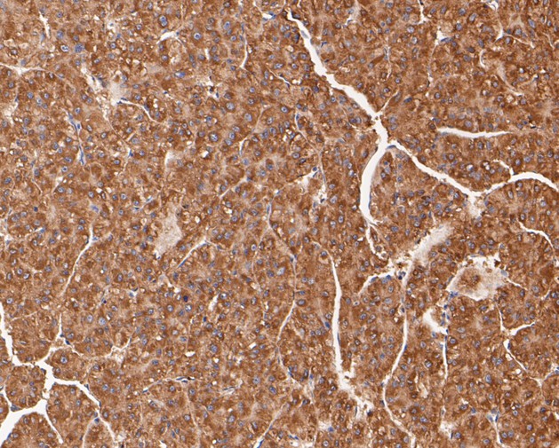 Immunohistochemical analysis of paraffin-embedded human liver carcinoma tissue using anti-TRPML3 antibody. The section was pre-treated using heat mediated antigen retrieval with sodium citrate buffer (pH 6.0) for 20 minutes. The tissues were blocked in 5% BSA for 30 minutes at room temperature, washed with ddH2O and PBS, and then probed with the primary antibody (ER1901-21, 1/50)  for 30 minutes at room temperature. The detection was performed using an HRP conjugated compact polymer system. DAB was used as the chromogen. Tissues were counterstained with hematoxylin and mounted with DPX.