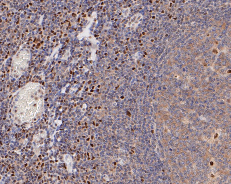 Immunohistochemical analysis of paraffin-embedded human tonsil tissue using anti-FoxP1 antibody. The section was pre-treated using heat mediated antigen retrieval with sodium citrate buffer (pH 6.0) for 20 minutes. The tissues were blocked in 5% BSA for 30 minutes at room temperature, washed with ddH2O and PBS, and then probed with the primary antibody (ER1901-25, 1/50)  for 30 minutes at room temperature. The detection was performed using an HRP conjugated compact polymer system. DAB was used as the chromogen. Tissues were counterstained with hematoxylin and mounted with DPX.