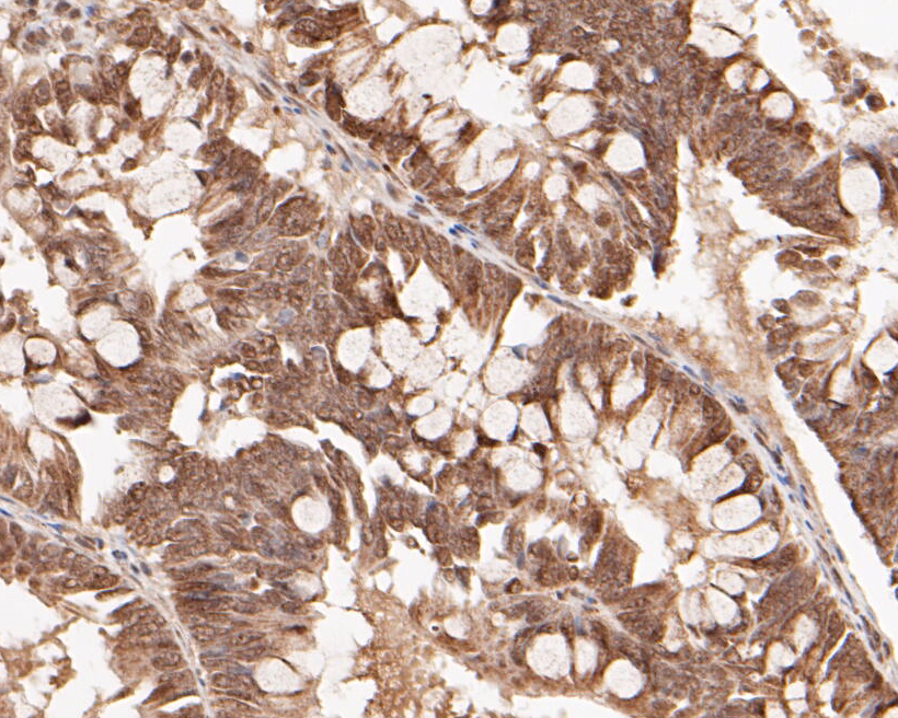 Immunohistochemical analysis of paraffin-embedded human colon tissue using anti-FoxP1 antibody. The section was pre-treated using heat mediated antigen retrieval with sodium citrate buffer (pH 6.0) for 20 minutes. The tissues were blocked in 5% BSA for 30 minutes at room temperature, washed with ddH2O and PBS, and then probed with the primary antibody (ER1901-26, 1/50)  for 30 minutes at room temperature. The detection was performed using an HRP conjugated compact polymer system. DAB was used as the chromogen. Tissues were counterstained with hematoxylin and mounted with DPX.