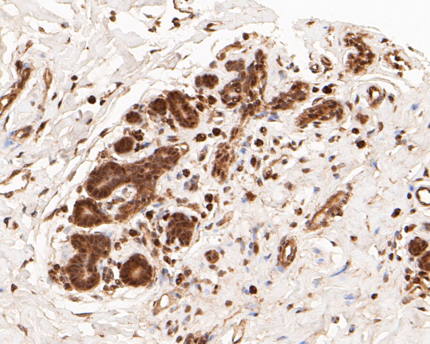 Immunohistochemical analysis of paraffin-embedded human breast tissue using anti-FoxP1 antibody. The section was pre-treated using heat mediated antigen retrieval with sodium citrate buffer (pH 6.0) for 20 minutes. The tissues were blocked in 5% BSA for 30 minutes at room temperature, washed with ddH2O and PBS, and then probed with the primary antibody (ER1901-26, 1/50)  for 30 minutes at room temperature. The detection was performed using an HRP conjugated compact polymer system. DAB was used as the chromogen. Tissues were counterstained with hematoxylin and mounted with DPX.