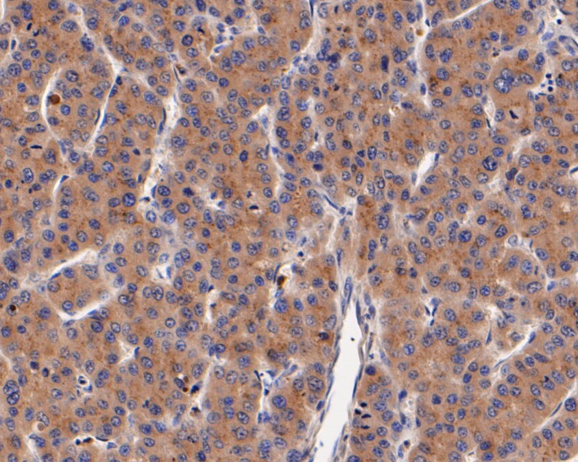 Immunohistochemical analysis of paraffin-embedded human liver carcinoma tissue using anti-DOG1 antibody. The section was pre-treated using heat mediated antigen retrieval with Tris-EDTA buffer (pH 8.0-8.4) for 20 minutes.The tissues were blocked in 5% BSA for 30 minutes at room temperature, washed with ddH2O and PBS, and then probed with the primary antibody (ER1901-30, 1/50) for 30 minutes at room temperature. The detection was performed using an HRP conjugated compact polymer system. DAB was used as the chromogen. Tissues were counterstained with hematoxylin and mounted with DPX.