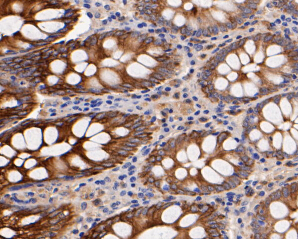 Immunohistochemical analysis of paraffin-embedded human colon  tissue using anti-CD68 antibody. The section was pre-treated using heat mediated antigen retrieval with Tris-EDTA buffer (pH 8.0-8.4) for 20 minutes.The tissues were blocked in 5% BSA for 30 minutes at room temperature, washed with ddH2O and PBS, and then probed with the primary antibody (ER1901-32, 1/50) for 30 minutes at room temperature. The detection was performed using an HRP conjugated compact polymer system. DAB was used as the chromogen. Tissues were counterstained with hematoxylin and mounted with DPX.