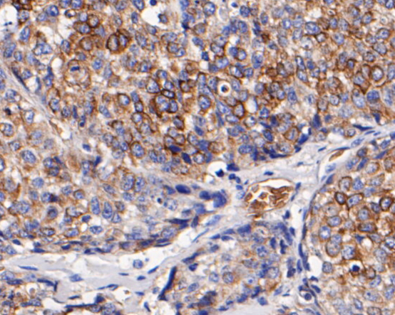 Immunohistochemical analysis of paraffin-embedded human lung carcinoma tissue using anti-CD68 antibody. The section was pre-treated using heat mediated antigen retrieval with Tris-EDTA buffer (pH 8.0-8.4) for 20 minutes.The tissues were blocked in 5% BSA for 30 minutes at room temperature, washed with ddH2O and PBS, and then probed with the primary antibody (ER1901-32, 1/50) for 30 minutes at room temperature. The detection was performed using an HRP conjugated compact polymer system. DAB was used as the chromogen. Tissues were counterstained with hematoxylin and mounted with DPX.