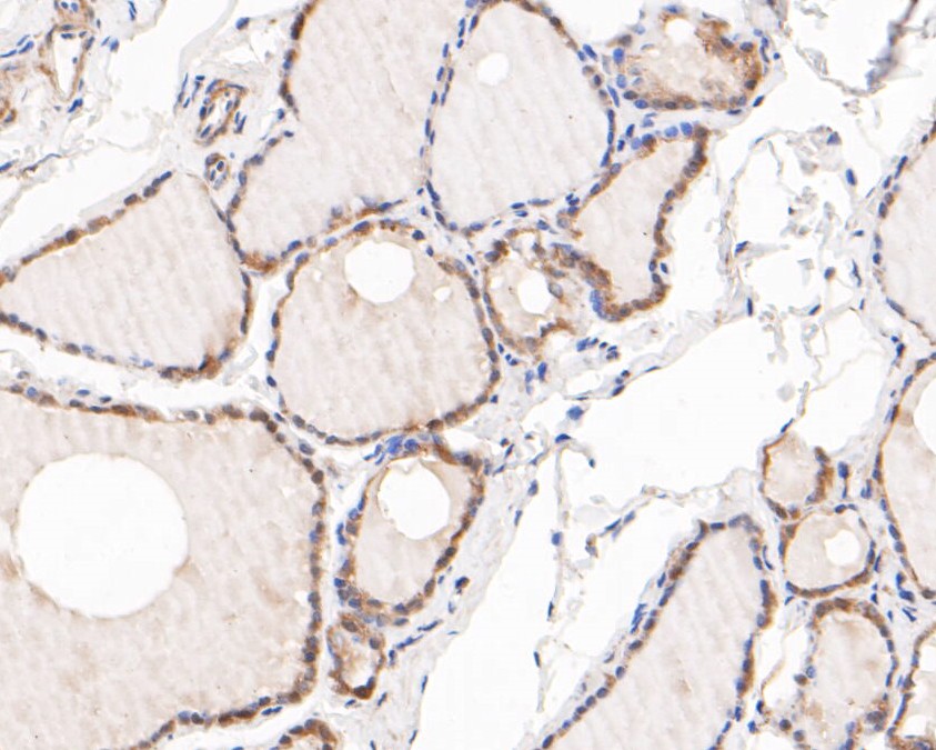 Immunohistochemical analysis of paraffin-embedded human thyroid tissue using anti-AKT3 antibody. The section was pre-treated using heat mediated antigen retrieval with sodium citrate buffer (pH 6.0) for 20 minutes. The tissues were blocked in 5% BSA for 30 minutes at room temperature, washed with ddH2O and PBS, and then probed with the primary antibody (ER1901-33, 1/200)  for 30 minutes at room temperature. The detection was performed using an HRP conjugated compact polymer system. DAB was used as the chromogen. Tissues were counterstained with hematoxylin and mounted with DPX.