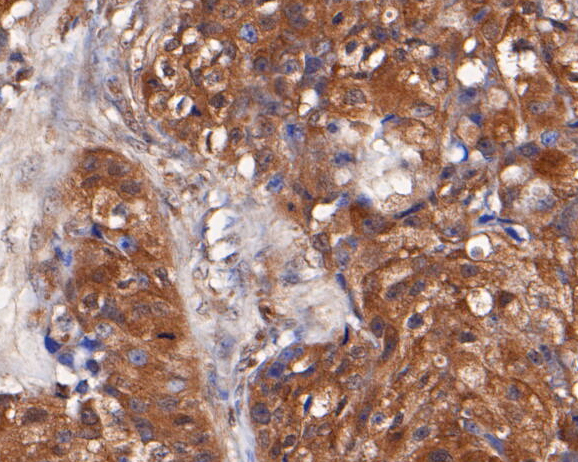 Immunohistochemical analysis of paraffin-embedded human breast carcinoma tissue using anti-TMX1 antibody. The section was pre-treated using heat mediated antigen retrieval with Tris-EDTA buffer (pH 8.0-8.4) for 20 minutes.The tissues were blocked in 5% BSA for 30 minutes at room temperature, washed with ddH2O and PBS, and then probed with the primary antibody (ER1901-36, 1/50) for 30 minutes at room temperature. The detection was performed using an HRP conjugated compact polymer system. DAB was used as the chromogen. Tissues were counterstained with hematoxylin and mounted with DPX.