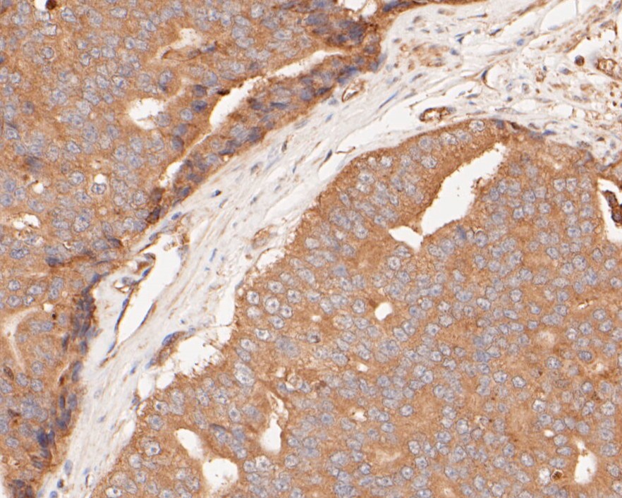 Immunohistochemical analysis of paraffin-embedded human prostate carcinoma tissue using anti-Gasdermin D (N terminal) antibody. The section was pre-treated using heat mediated antigen retrieval with sodium citrate buffer (pH 6.0) for 20 minutes. The tissues were blocked in 5% BSA for 30 minutes at room temperature, washed with ddH2O and PBS, and then probed with the primary antibody (ER1901-37, 1/50)  for 30 minutes at room temperature. The detection was performed using an HRP conjugated compact polymer system. DAB was used as the chromogen. Tissues were counterstained with hematoxylin and mounted with DPX.