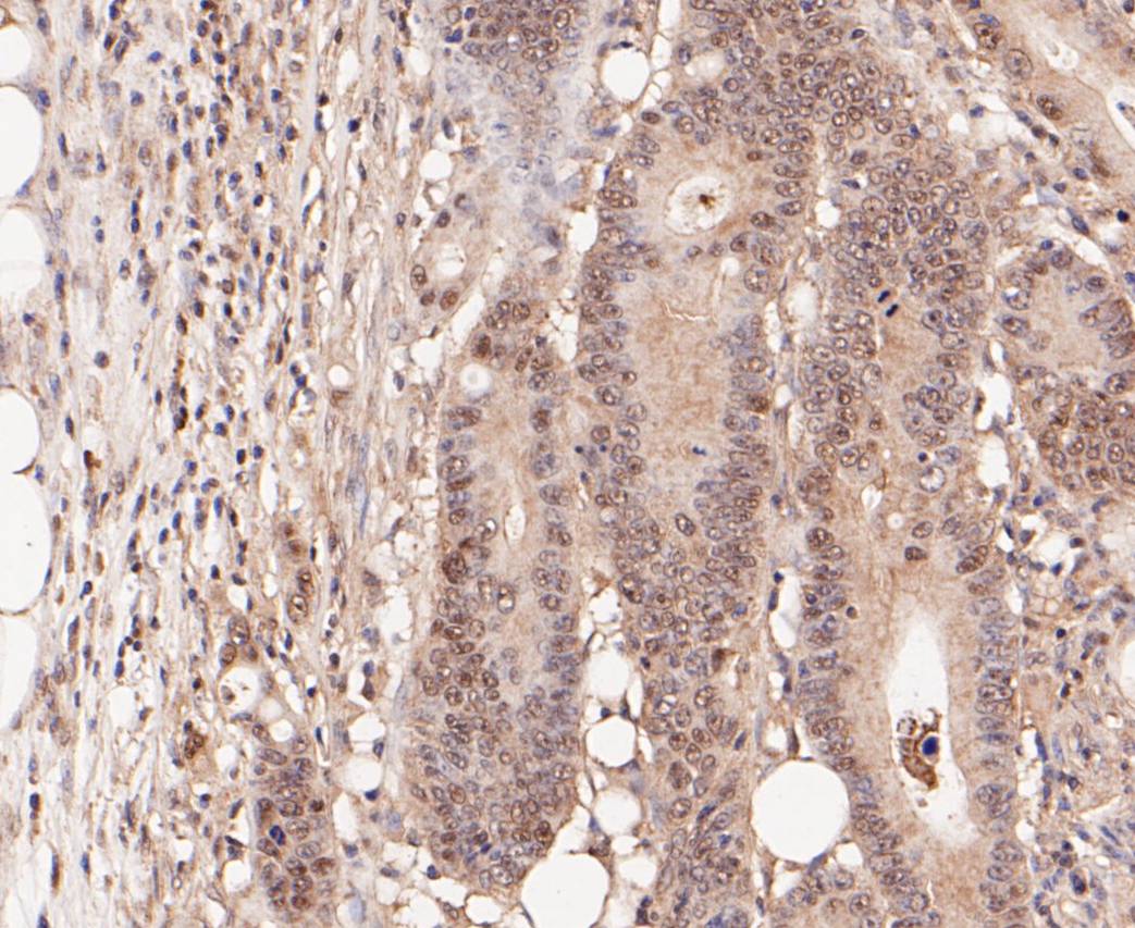 Immunohistochemical analysis of paraffin-embedded human colon cancer tissue using anti-BIN1 antibody. The section was pre-treated using heat mediated antigen retrieval with Tris-EDTA buffer (pH 8.0-8.4) for 20 minutes.The tissues were blocked in 5% BSA for 30 minutes at room temperature, washed with ddH2O and PBS, and then probed with the primary antibody (ER1901-39, 1/50) for 30 minutes at room temperature. The detection was performed using an HRP conjugated compact polymer system. DAB was used as the chromogen. Tissues were counterstained with hematoxylin and mounted with DPX.
