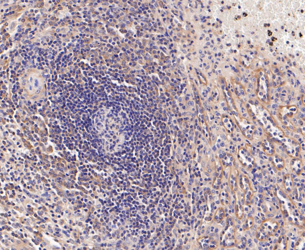 Immunohistochemical analysis of paraffin-embedded human spleen tissue using anti-BIN1 antibody. The section was pre-treated using heat mediated antigen retrieval with Tris-EDTA buffer (pH 8.0-8.4) for 20 minutes.The tissues were blocked in 5% BSA for 30 minutes at room temperature, washed with ddH2O and PBS, and then probed with the primary antibody (ER1901-39, 1/200) for 30 minutes at room temperature. The detection was performed using an HRP conjugated compact polymer system. DAB was used as the chromogen. Tissues were counterstained with hematoxylin and mounted with DPX.