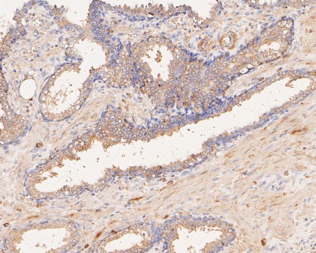 Immunohistochemical analysis of paraffin-embedded human prostate carcinoma tissue using anti-P2RX1 antibody. The section was pre-treated using heat mediated antigen retrieval with Tris-EDTA buffer (pH 8.0-8.4) for 20 minutes.The tissues were blocked in 5% BSA for 30 minutes at room temperature, washed with ddH2O and PBS, and then probed with the primary antibody (ER1901-53, 1/50) for 30 minutes at room temperature. The detection was performed using an HRP conjugated compact polymer system. DAB was used as the chromogen. Tissues were counterstained with hematoxylin and mounted with DPX.