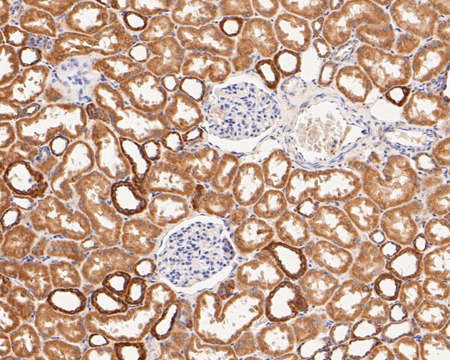 Immunohistochemical analysis of paraffin-embedded human kidney carcinoma tissue using anti-P2RX1 antibody. The section was pre-treated using heat mediated antigen retrieval with Tris-EDTA buffer (pH 8.0-8.4) for 20 minutes.The tissues were blocked in 5% BSA for 30 minutes at room temperature, washed with ddH2O and PBS, and then probed with the primary antibody (ER1901-53, 1/50) for 30 minutes at room temperature. The detection was performed using an HRP conjugated compact polymer system. DAB was used as the chromogen. Tissues were counterstained with hematoxylin and mounted with DPX.