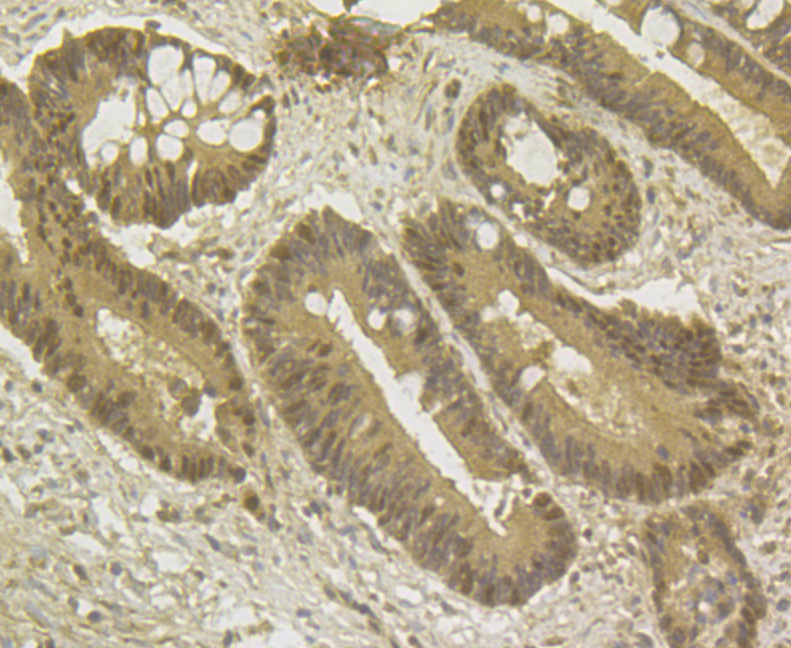 Immunohistochemical analysis of paraffin-embedded human colon cancer tissue using anti-GAPDH antibody. The section was pre-treated using heat mediated antigen retrieval with sodium citrate buffer (pH 6.0) for 20 minutes. The tissues were blocked in 5% BSA for 30 minutes at room temperature, washed with ddH2O and PBS, and then probed with the antibody (ER1901-65) at 1/50 dilution, for 30 minutes at room temperature and detected using an HRP conjugated compact polymer system. DAB was used as the chromogen. Counter stained with hematoxylin and mounted with DPX.
