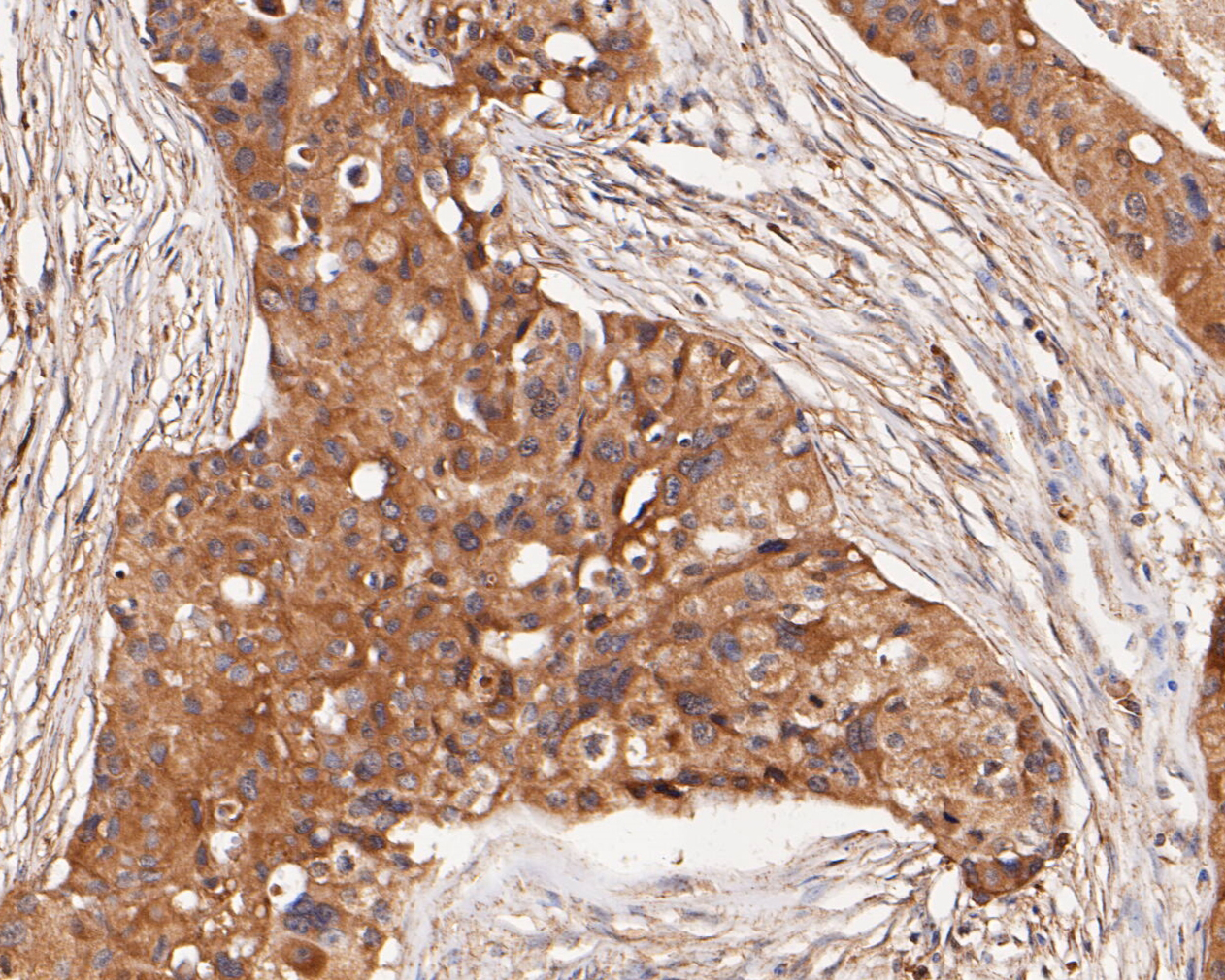 Immunohistochemical analysis of paraffin-embedded human breast carcinoma tissue using anti-GABRB1 antibody. The section was pre-treated using heat mediated antigen retrieval with Tris-EDTA buffer (pH 8.0-8.4) for 20 minutes.The tissues were blocked in 5% BSA for 30 minutes at room temperature, washed with ddH2O and PBS, and then probed with the primary antibody (ER1901-66, 1/50) for 30 minutes at room temperature. The detection was performed using an HRP conjugated compact polymer system. DAB was used as the chromogen. Tissues were counterstained with hematoxylin and mounted with DPX.