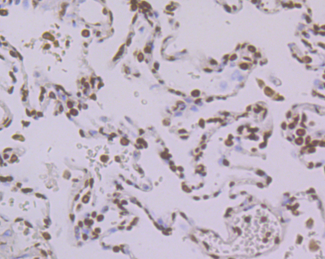 Immunohistochemical analysis of paraffin-embedded human lung cancer  tissue using anti-Histone H2A.x antibody. The section was pre-treated using heat mediated antigen retrieval with sodium citrate buffer (pH 6.0) for 20 minutes. The tissues were blocked in 5% BSA for 30 minutes at room temperature, washed with ddH2O and PBS, and then probed with the primary antibody (ER1901-70, 1/100)  for 30 minutes at room temperature. The detection was performed using an HRP conjugated compact polymer system. DAB was used as the chromogen. Tissues were counterstained with hematoxylin and mounted with DPX.
