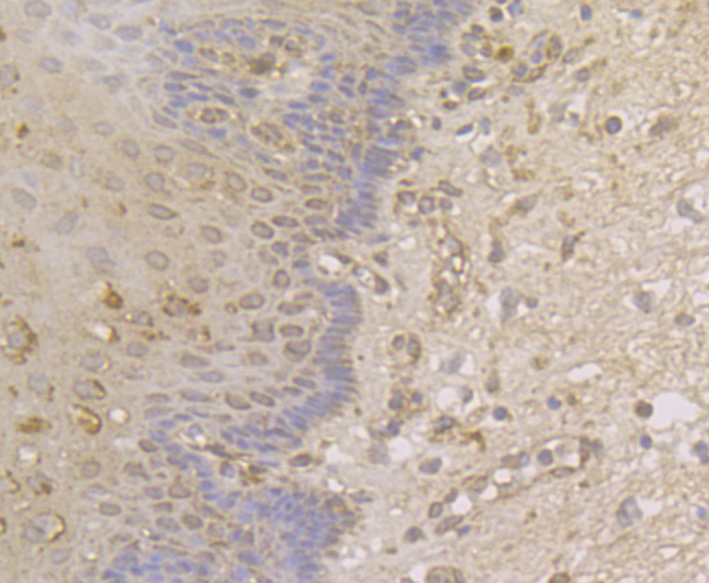 Immunohistochemical analysis of paraffin-embedded human esophagus cancer tissue using anti-p15 INK4b antibody. The section was pre-treated using heat mediated antigen retrieval with Tris-EDTA buffer (pH 8.0-8.4) for 20 minutes.The tissues were blocked in 5% BSA for 30 minutes at room temperature, washed with ddH2O and PBS, and then probed with the antibody (ER1901-75) at 1/50 dilution, for 30 minutes at room temperature and detected using an HRP conjugated compact polymer system. DAB was used as the chromogen. Counter stained with hematoxylin and mounted with DPX.
