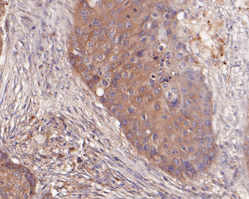 Immunohistochemical analysis of paraffin-embedded human breast cancer tissue using anti-delta 1 Catenin/CAS antibody. The section was pre-treated using heat mediated antigen retrieval with Tris-EDTA buffer (pH 8.0-8.4) for 20 minutes.The tissues were blocked in 5% BSA for 30 minutes at room temperature, washed with ddH2O and PBS, and then probed with the primary antibody (ER1901-80, 1/50) for 30 minutes at room temperature. The detection was performed using an HRP conjugated compact polymer system. DAB was used as the chromogen. Tissues were counterstained with hematoxylin and mounted with DPX.