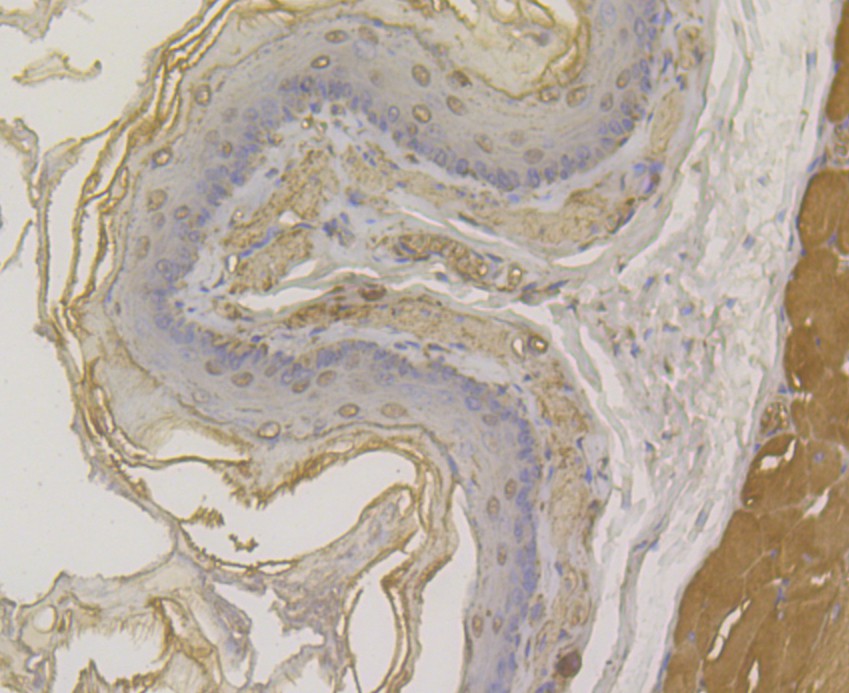 Immunohistochemical analysis of paraffin-embedded human esophagus cancer tissue using anti-DSG3 antibody. The section was pre-treated using heat mediated antigen retrieval with Tris-EDTA buffer (pH 8.0-8.4) for 20 minutes.The tissues were blocked in 5% BSA for 30 minutes at room temperature, washed with ddH2O and PBS, and then probed with the antibody (ER1901-81) at 1/200 dilution, for 30 minutes at room temperature and detected using an HRP conjugated compact polymer system. DAB was used as the chrogen. Counter stained with hematoxylin and mounted with DPX.
