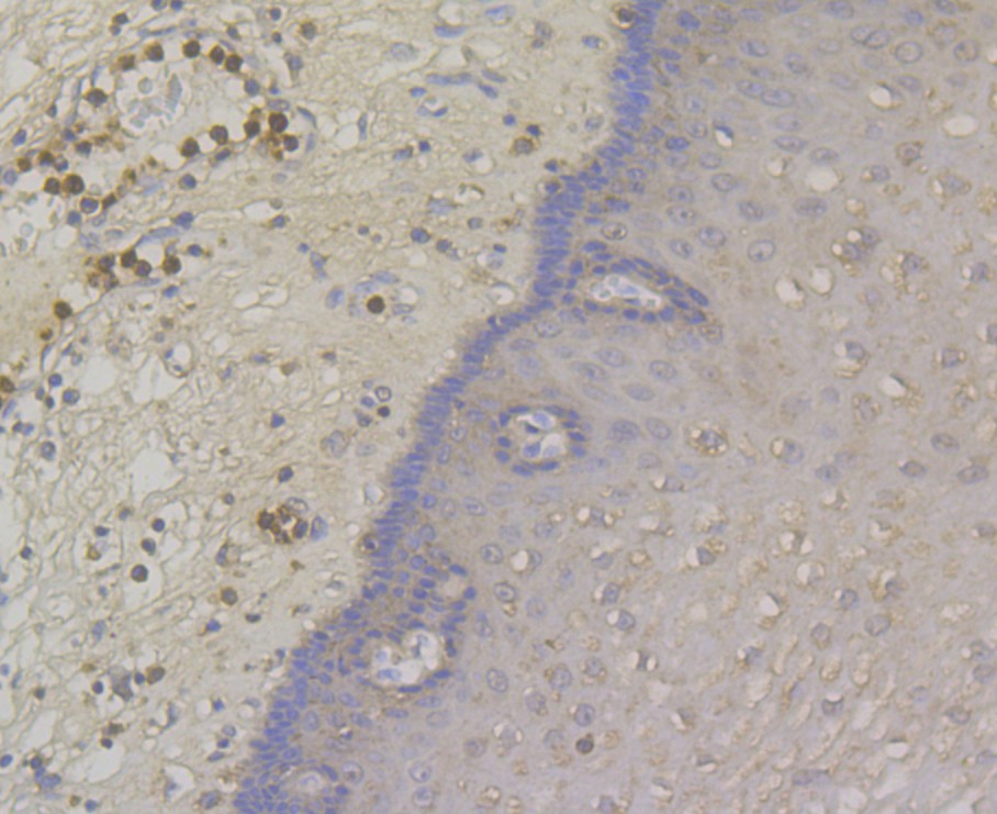 Immunohistochemical analysis of paraffin-embedded human esophagus cancer tissue using anti-DSG3 antibody. The section was pre-treated using heat mediated antigen retrieval with Tris-EDTA buffer (pH 8.0-8.4) for 20 minutes.The tissues were blocked in 5% BSA for 30 minutes at room temperature, washed with ddH2O and PBS, and then probed with the antibody (ER1901-81) at 1/200 dilution, for 30 minutes at room temperature and detected using an HRP conjugated compact polymer system. DAB was used as the chrogen. Counter stained with hematoxylin and mounted with DPX.