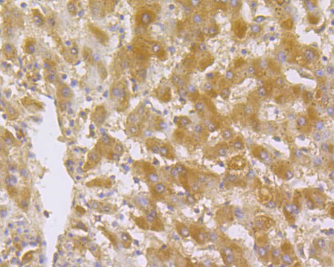 Immunohistochemical analysis of paraffin-embedded Human liver cancer tissue using anti-ITCH antibody. The section was pre-treated using heat mediated antigen retrieval with Tris-EDTA buffer (pH 8.0-8.4) for 20 minutes.The tissues were blocked in 5% BSA for 30 minutes at room temperature, washed with ddH2O and PBS, and then probed with the primary antibody (ER1901-94, 1/50) for 30 minutes at room temperature. The detection was performed using an HRP conjugated compact polymer system. DAB was used as the chromogen. Tissues were counterstained with hematoxylin and mounted with DPX.