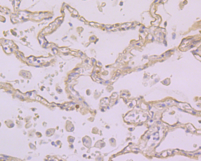 Immunohistochemical analysis of paraffin-embedded human lung cancer tissue using anti-FOLR1 antibody. The section was pre-treated using heat mediated antigen retrieval with Tris-EDTA buffer (pH 8.0-8.4) for 20 minutes.The tissues were blocked in 5% BSA for 30 minutes at room temperature, washed with ddH2O and PBS, and then probed with the primary antibody (ER1901-95, 1/100) for 30 minutes at room temperature. The detection was performed using an HRP conjugated compact polymer system. DAB was used as the chromogen. Tissues were counterstained with hematoxylin and mounted with DPX.