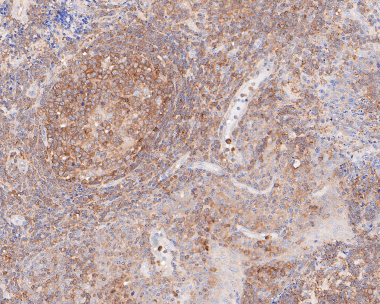 Immunohistochemical analysis of paraffin-embedded human tonsil tissue using anti-Cytokeratin 20 antibody. The section was pre-treated using heat mediated antigen retrieval with Tris-EDTA buffer (pH 8.0-8.4) for 20 minutes.The tissues were blocked in 5% BSA for 30 minutes at room temperature, washed with ddH2O and PBS, and then probed with the primary antibody (ER1901-97, 1/200) for 30 minutes at room temperature. The detection was performed using an HRP conjugated compact polymer system. DAB was used as the chromogen. Tissues were counterstained with hematoxylin and mounted with DPX.