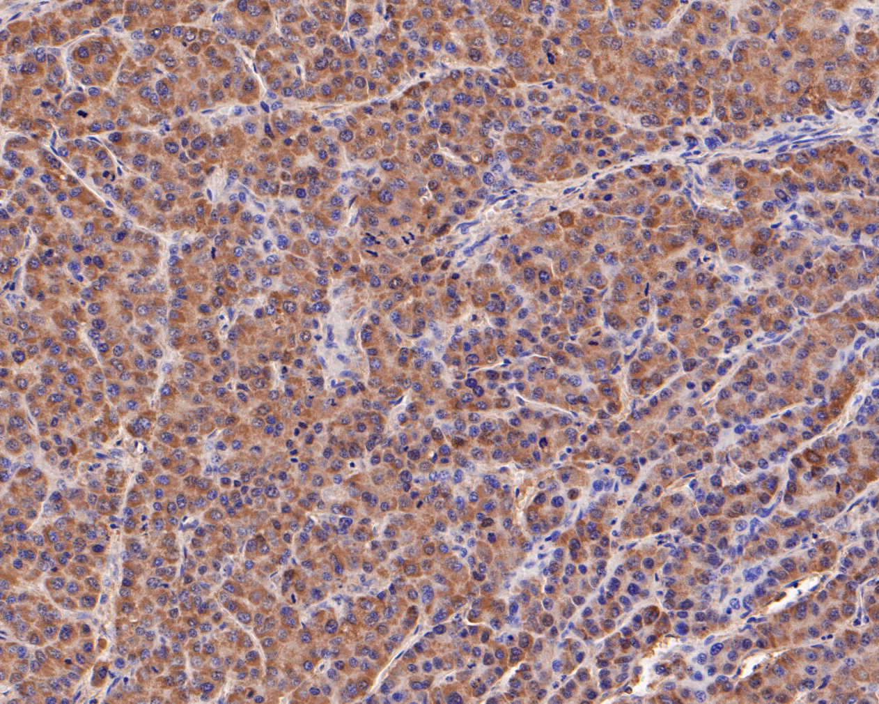 Immunohistochemical analysis of paraffin-embedded human liver carcinoma tissue using anti-FH antibody. The section was pre-treated using heat mediated antigen retrieval with Tris-EDTA buffer (pH 8.0-8.4) for 20 minutes.The tissues were blocked in 5% BSA for 30 minutes at room temperature, washed with ddH2O and PBS, and then probed with the primary antibody (ER1902-01, 1/200) for 30 minutes at room temperature. The detection was performed using an HRP conjugated compact polymer system. DAB was used as the chromogen. Tissues were counterstained with hematoxylin and mounted with DPX.