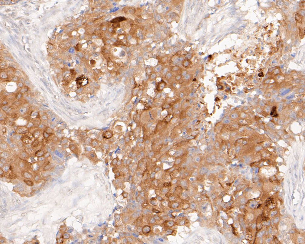 Immunohistochemical analysis of paraffin-embedded human breast carcinoma tissue using anti-Muc1 antibody. The section was pre-treated using heat mediated antigen retrieval with sodium citrate buffer (pH 6.0) for 20 minutes. The tissues were blocked in 5% BSA for 30 minutes at room temperature, washed with ddH2O and PBS, and then probed with the primary antibody (ER1902-10, 1/200)  for 30 minutes at room temperature. The detection was performed using an HRP conjugated compact polymer system. DAB was used as the chromogen. Tissues were counterstained with hematoxylin and mounted with DPX.