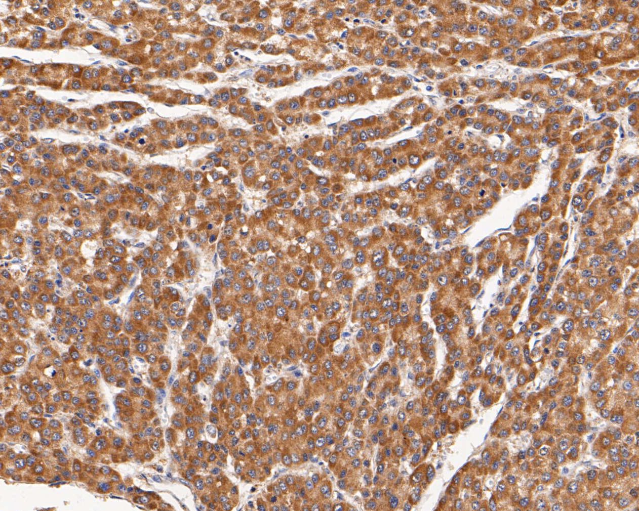 Immunohistochemical analysis of paraffin-embedded human liver carcinoma tissue using anti-CHRNA3 antibody. The section was pre-treated using heat mediated antigen retrieval with Tris-EDTA buffer (pH 8.0-8.4) for 20 minutes.The tissues were blocked in 5% BSA for 30 minutes at room temperature, washed with ddH2O and PBS, and then probed with the primary antibody (ER1902-13, 1/50) for 30 minutes at room temperature. The detection was performed using an HRP conjugated compact polymer system. DAB was used as the chromogen. Tissues were counterstained with hematoxylin and mounted with DPX.