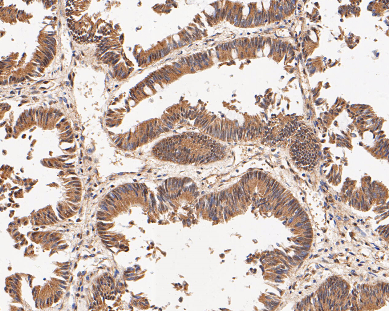 Immunohistochemical analysis of paraffin-embedded human colon carcinoma tissue using anti-CHRNA3 antibody. The section was pre-treated using heat mediated antigen retrieval with Tris-EDTA buffer (pH 8.0-8.4) for 20 minutes.The tissues were blocked in 5% BSA for 30 minutes at room temperature, washed with ddH2O and PBS, and then probed with the primary antibody (ER1902-13, 1/50) for 30 minutes at room temperature. The detection was performed using an HRP conjugated compact polymer system. DAB was used as the chromogen. Tissues were counterstained with hematoxylin and mounted with DPX.