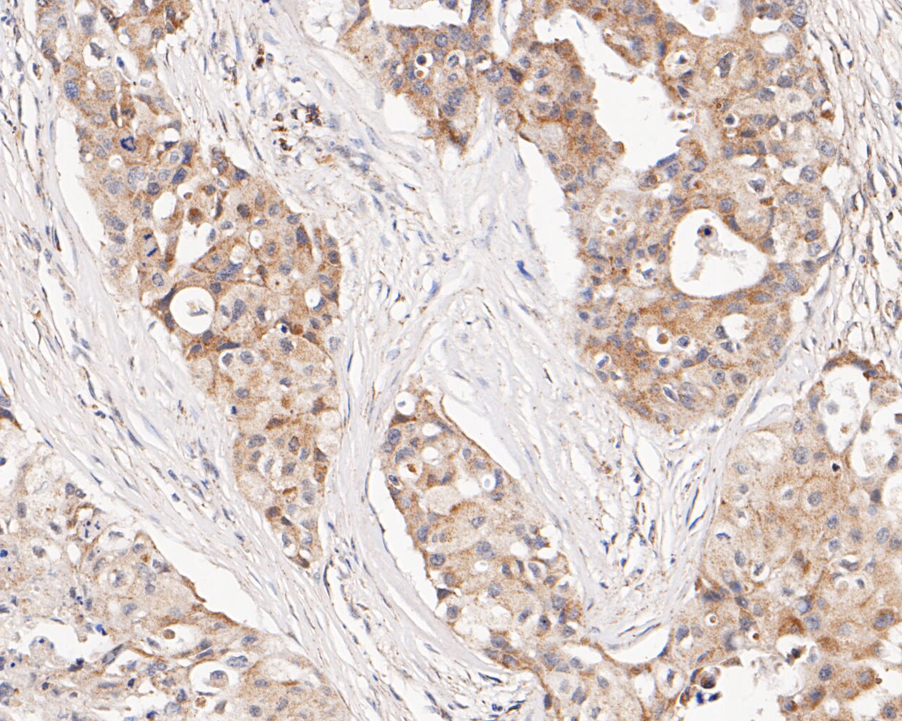 Immunohistochemical analysis of paraffin-embedded human breast carcinoma tissue using anti-CHRNA3 antibody. The section was pre-treated using heat mediated antigen retrieval with Tris-EDTA buffer (pH 8.0-8.4) for 20 minutes.The tissues were blocked in 5% BSA for 30 minutes at room temperature, washed with ddH2O and PBS, and then probed with the primary antibody (ER1902-13, 1/50) for 30 minutes at room temperature. The detection was performed using an HRP conjugated compact polymer system. DAB was used as the chromogen. Tissues were counterstained with hematoxylin and mounted with DPX.