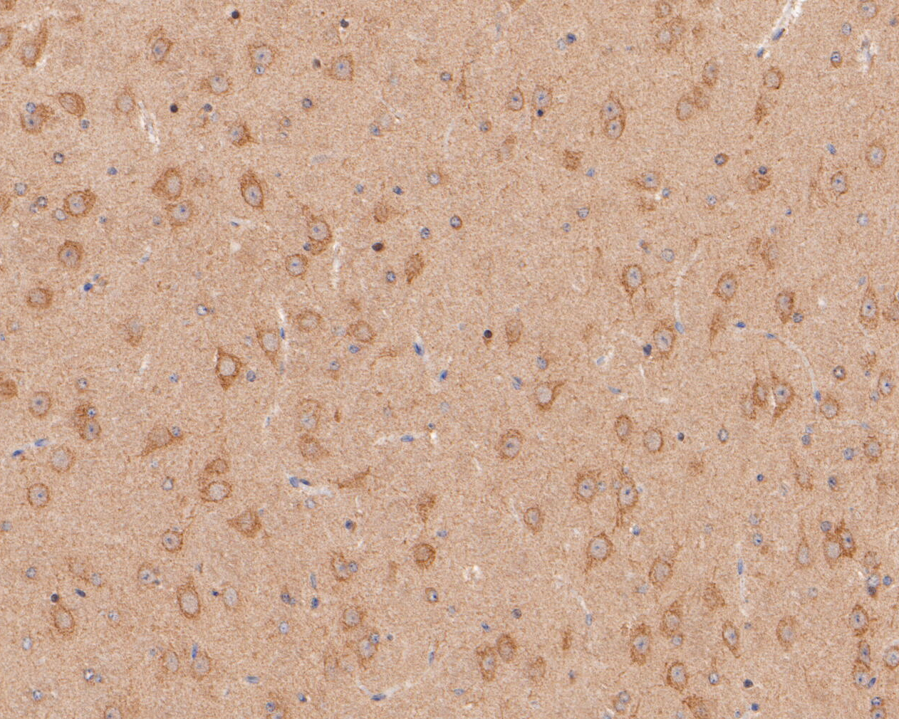 Immunohistochemical analysis of paraffin-embedded human tonsil carcinoma tissue using anti-CHRNA3 antibody. The section was pre-treated using heat mediated antigen retrieval with Tris-EDTA buffer (pH 8.0-8.4) for 20 minutes.The tissues were blocked in 5% BSA for 30 minutes at room temperature, washed with ddH2O and PBS, and then probed with the primary antibody (ER1902-13, 1/200) for 30 minutes at room temperature. The detection was performed using an HRP conjugated compact polymer system. DAB was used as the chromogen. Tissues were counterstained with hematoxylin and mounted with DPX.
