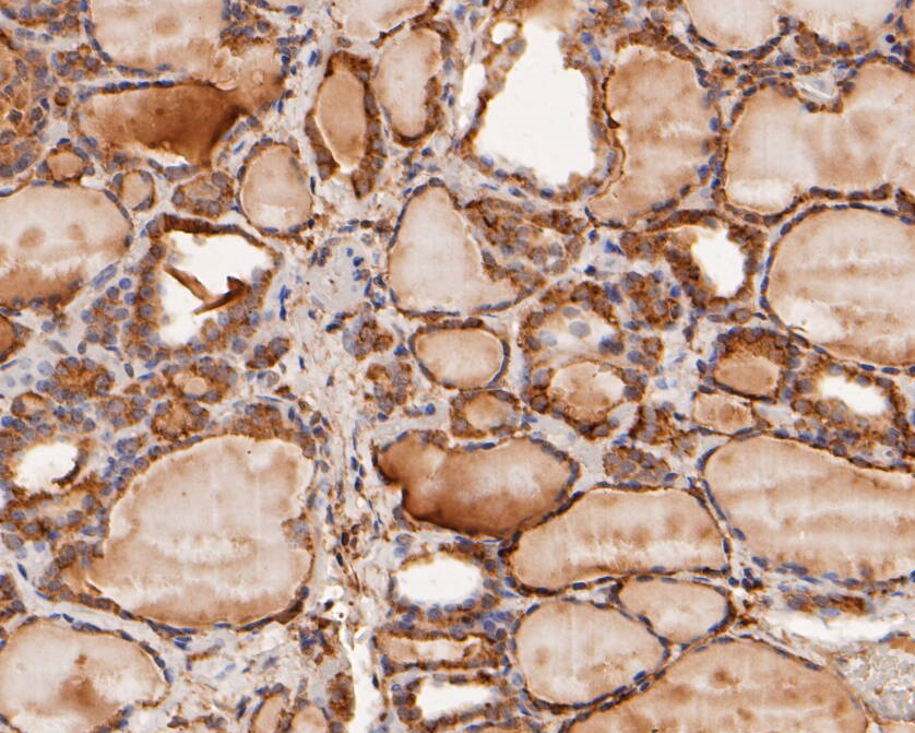 Immunohistochemical analysis of paraffin-embedded human thyroid tissue using anti-MDM2 antibody. The section was pre-treated using heat mediated antigen retrieval with sodium citrate buffer (pH 6.0) for 20 minutes. The tissues were blocked in 5% BSA for 30 minutes at room temperature, washed with ddH2O and PBS, and then probed with the primary antibody (ER1902-14, 1/1,000)  for 30 minutes at room temperature. The detection was performed using an HRP conjugated compact polymer system. DAB was used as the chromogen. Tissues were counterstained with hematoxylin and mounted with DPX.