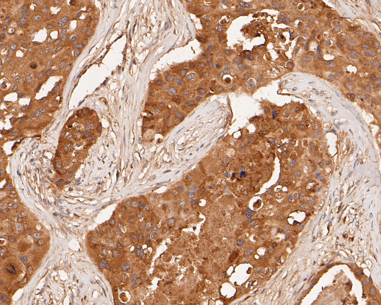 Immunohistochemical analysis of paraffin-embedded human breast carcinoma tissue using anti-MDM2 antibody. The section was pre-treated using heat mediated antigen retrieval with sodium citrate buffer (pH 6.0) for 20 minutes. The tissues were blocked in 5% BSA for 30 minutes at room temperature, washed with ddH2O and PBS, and then probed with the primary antibody (ER1902-14, 1/1,000)  for 30 minutes at room temperature. The detection was performed using an HRP conjugated compact polymer system. DAB was used as the chromogen. Tissues were counterstained with hematoxylin and mounted with DPX.