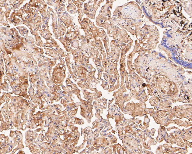 Immunohistochemical analysis of paraffin-embedded human lung tissue using anti-GSDMC antibody. The section was pre-treated using heat mediated antigen retrieval with Tris-EDTA buffer (pH 8.0-8.4) for 20 minutes.The tissues were blocked in 5% BSA for 30 minutes at room temperature, washed with ddH2O and PBS, and then probed with the primary antibody (ER1902-22, 1/200) for 30 minutes at room temperature. The detection was performed using an HRP conjugated compact polymer system. DAB was used as the chromogen. Tissues were counterstained with hematoxylin and mounted with DPX.