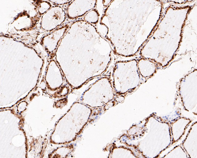 Immunohistochemical analysis of paraffin-embedded human thyroid tissue using anti-PTEN antibody. The section was pre-treated using heat mediated antigen retrieval with Tris-EDTA buffer (pH 8.0-8.4) for 20 minutes.The tissues were blocked in 5% BSA for 30 minutes at room temperature, washed with ddH2O and PBS, and then probed with the primary antibody (ER1902-27, 1/50) for 30 minutes at room temperature. The detection was performed using an HRP conjugated compact polymer system. DAB was used as the chromogen. Tissues were counterstained with hematoxylin and mounted with DPX.