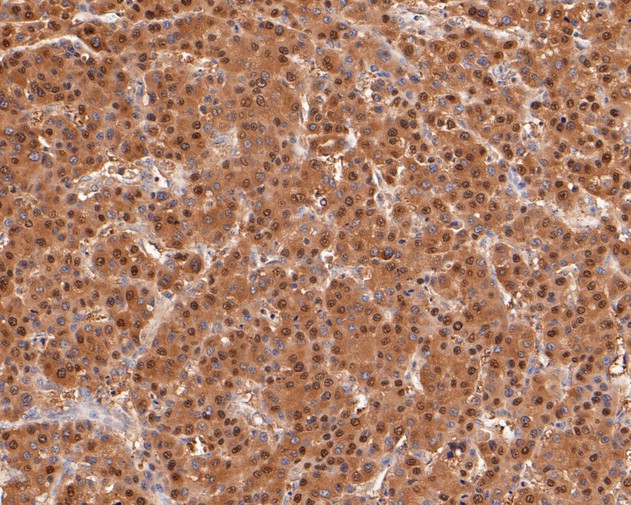 Immunohistochemical analysis of paraffin-embedded human liver carcinoma tissue using anti-TMX4 antibody. The section was pre-treated using heat mediated antigen retrieval with Tris-EDTA buffer (pH 8.0-8.4) for 20 minutes.The tissues were blocked in 5% BSA for 30 minutes at room temperature, washed with ddH2O and PBS, and then probed with the primary antibody (ER1902-31, 1/50) for 30 minutes at room temperature. The detection was performed using an HRP conjugated compact polymer system. DAB was used as the chromogen. Tissues were counterstained with hematoxylin and mounted with DPX.